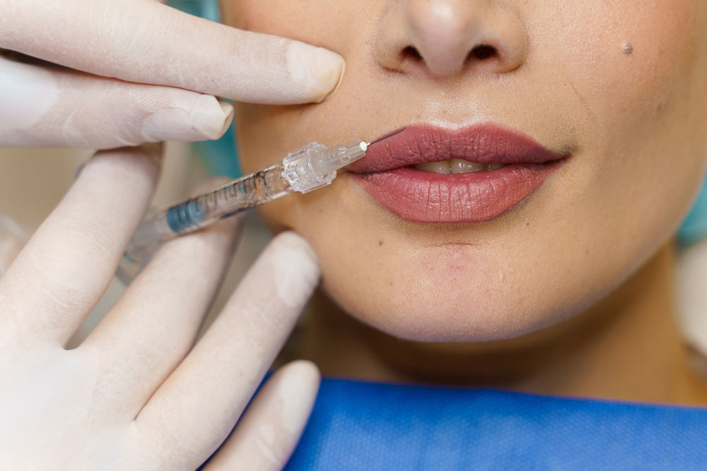 Russian Lip Fillers