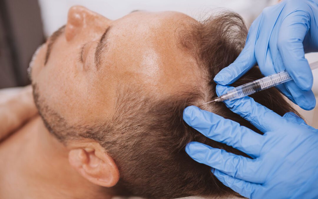 best hair loss treatment prp hair loss treatment PRP for Hair Re-growth