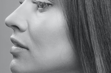 Fat-dissolving injections on Chin