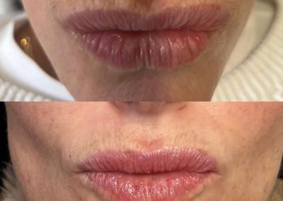 botox treatment wrinkles around lips