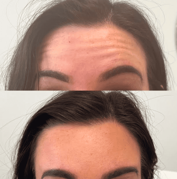 Botox treatment anti-ageing