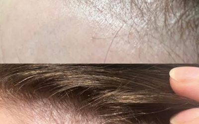 PRP for hair thinning