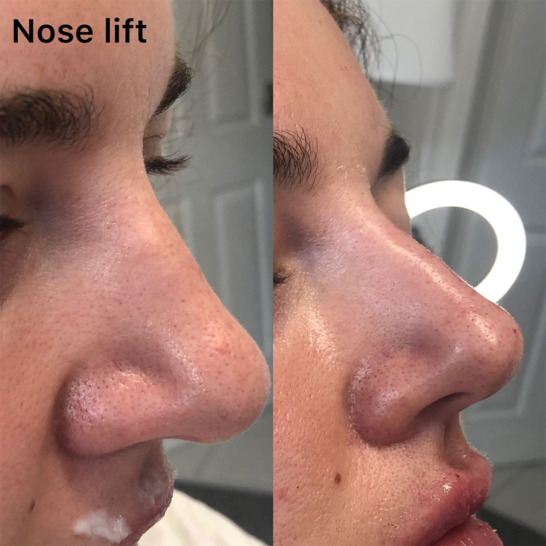 nose lift before and after