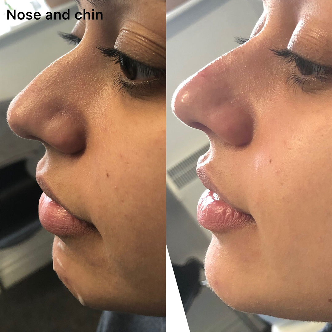 nose filler and cheek fillers