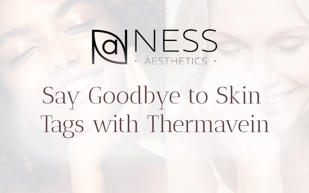 skin tag removal thermavein