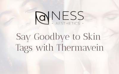 Say Goodbye to Skin Tags with Thermavein