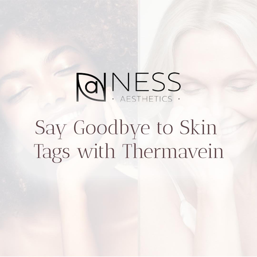 skin tag removal thermavein