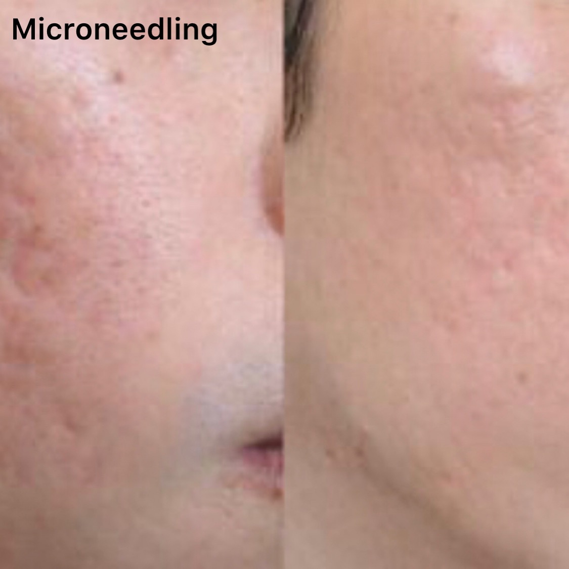 microneedling treatment