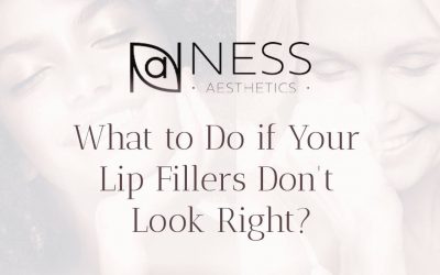 What to Do if Your Lip Fillers Don’t Look Right
