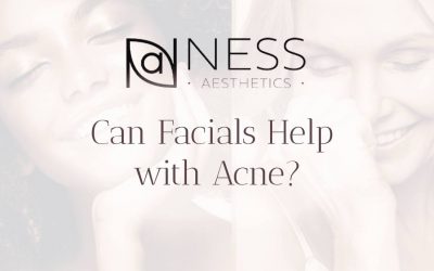 Can Facials Help with Acne?