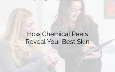 How Chemical Peels Reveal Your Best Skin