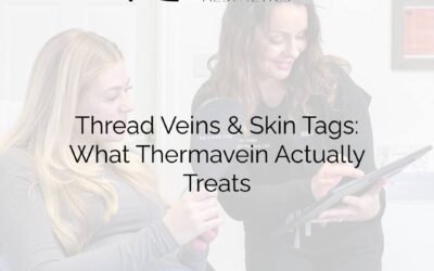 Thread Veins & Skin Tags: What Thermavein Actually Treats